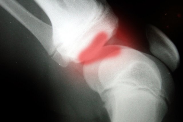 MITF Multiple Injury Trust Fund